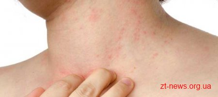 З 26 по 29 жовтня в області проводять безкоштовні обстеження на псоріаз